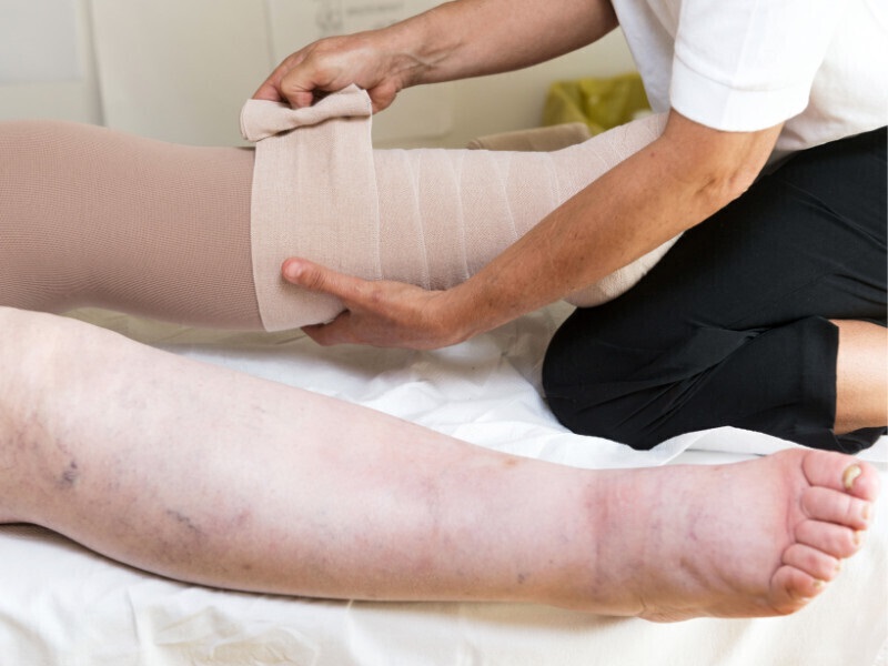 What’s Secondary Lymphedema?